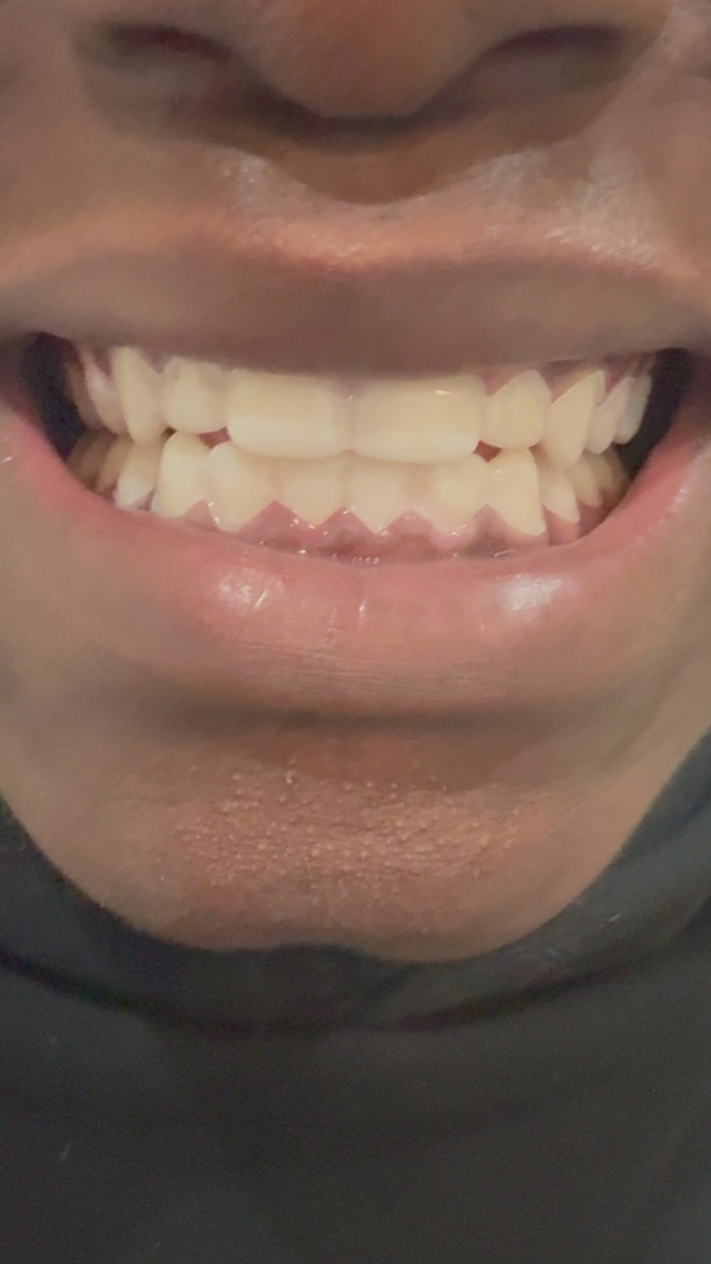 Pop on Smile Covers