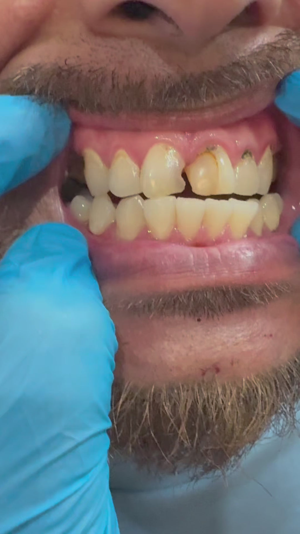 Pop on Smile Covers