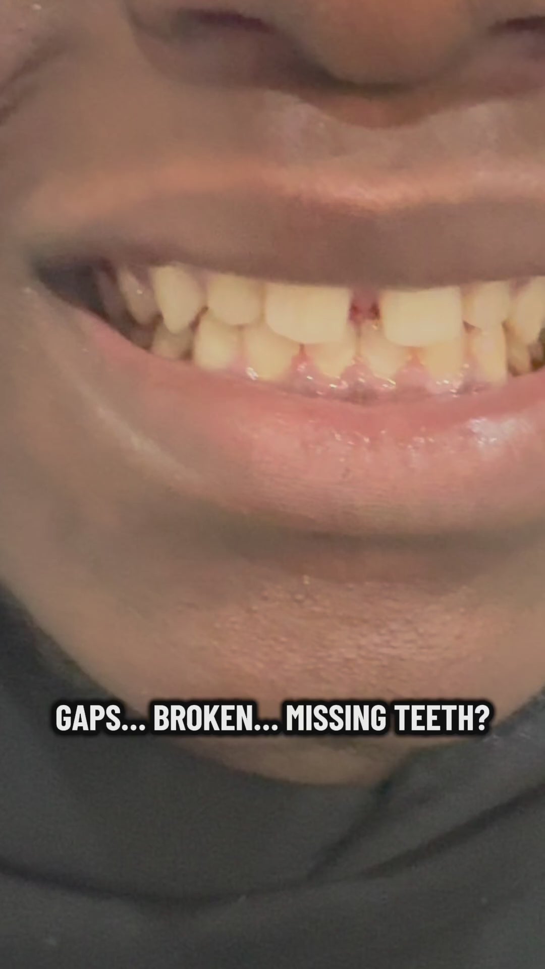Pop on Smile Covers